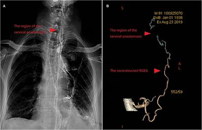 Simultaneous Vascular Reconstruction and Cervical Anastomosis in McKeown Esophagectomy